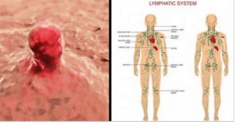 O sistema linfático doente permite que o câncer se espalhe ...