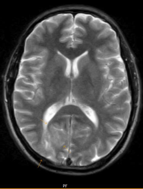 Occipital Cortical Dysplasia   Sumer s Radiology Blog