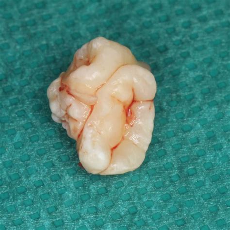 Odontoma is a benign tumor linked to tooth development | Dental ...