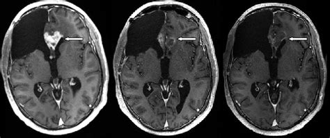 Omniprex News   La mitad de los tumores cerebrales son ...