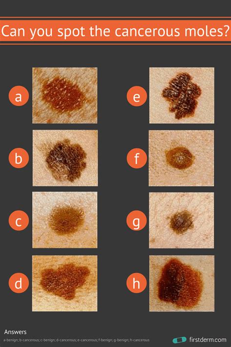 Online Dermatology Can you spot the cancerous mole?