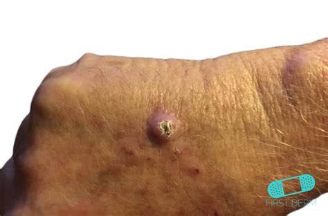 Online Dermatology   Squamous Cell Carcinoma