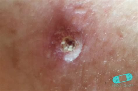 Online Dermatology Squamous Cell Carcinoma