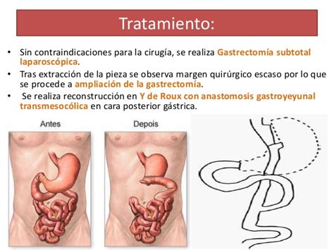 Operacion Cancer De Estomago SEONegativo.com