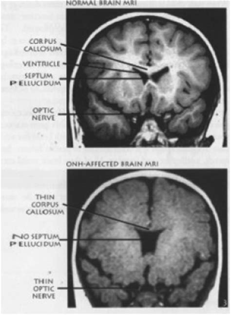 Optic Nerve Hypoplasia and Septo Optic Dysplasia ...