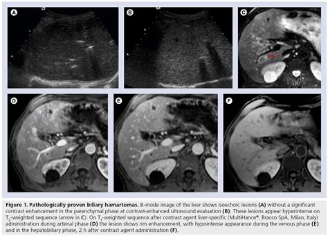 Optimal imaging of focal liver lesions