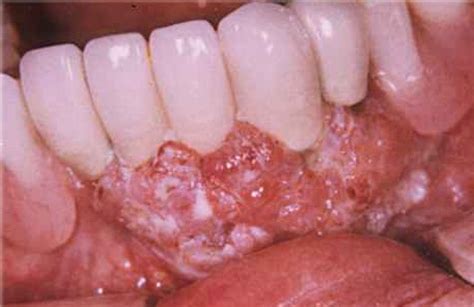 Oral Cancer   Causes, Symptoms, Treatment, Pictures, Signs ...