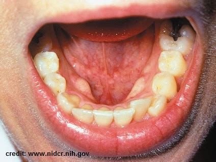 Oral Cancer Help | About oral cancer, help people!