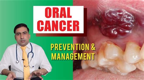 ORAL CANCER | MOUTH CANCER | Symptoms & Treatment | Dr ...