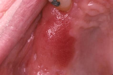 Oral Cancer   Premalignant Lesions