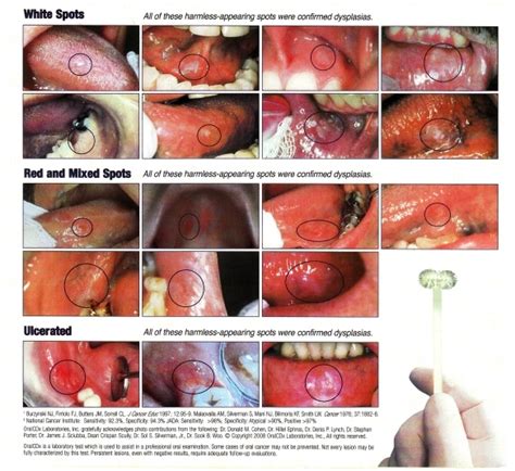 Oral Cancer: Risk Factors Part 3 and Symptoms ...