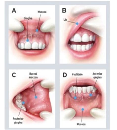 Oral Cancer Screening Examination   Pearly Whites Plus