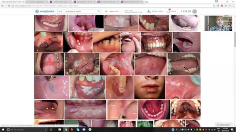Oral Cancer   Signs and Symptoms   YouTube