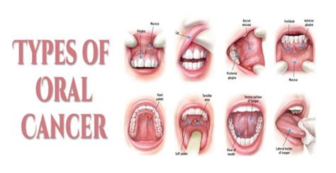 Oral Cancer: Symptoms, Causes And Risk Factors