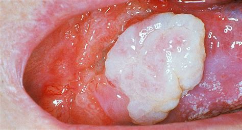 Oral Cancer: Symptoms, Causes, Treatments, and More