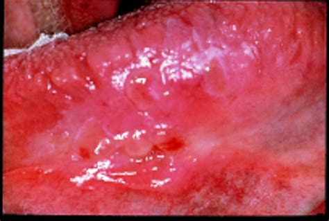 Oral cancer | The BMJ