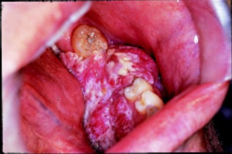 Oral cancer | The BMJ
