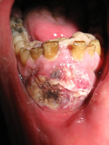 oral carcinoma / mouth cancer, staging: T4N2M0 | Flickr ...