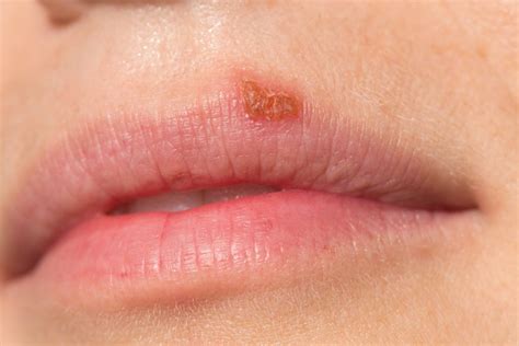 Oral Herpes | Triggers, Diagnosis & Treatment