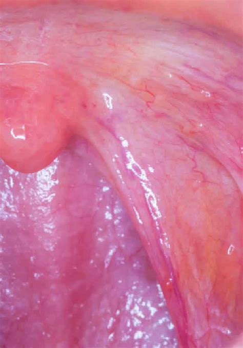 Oral Squamous Cell Carcinoma in Young Population — Risk ...