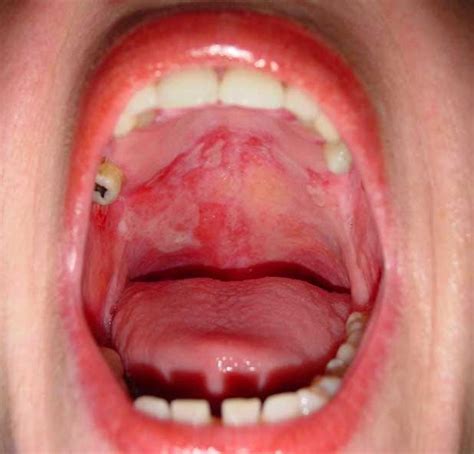 Oral Surgeons: Oral Cancer Pictures