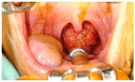 Oropharyngeal Neoplasms; Cancer of Oropharnyx ...