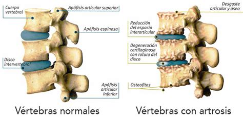 Osteoartritis y quiropráctica   Barcelona Quiropractic
