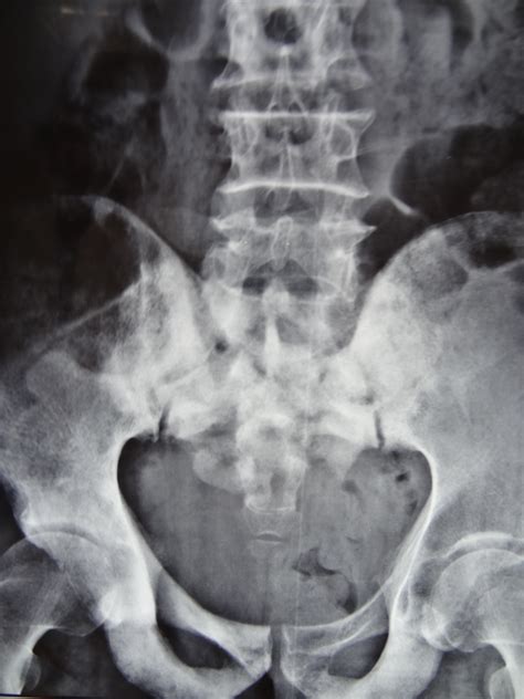 Osteoblastic metastases from prostate carcinoma | Image ...