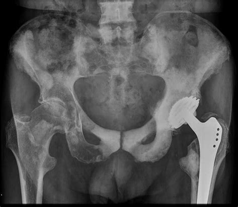 Osteoblastic metastases prostate carcinoma | Image ...