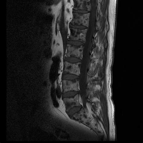 Osteoblastic vertebral metastases | Radiology Case ...