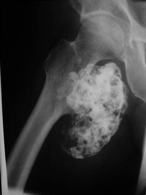 Osteochondroma : Bone Tumor Cancer : Tumors of the bone