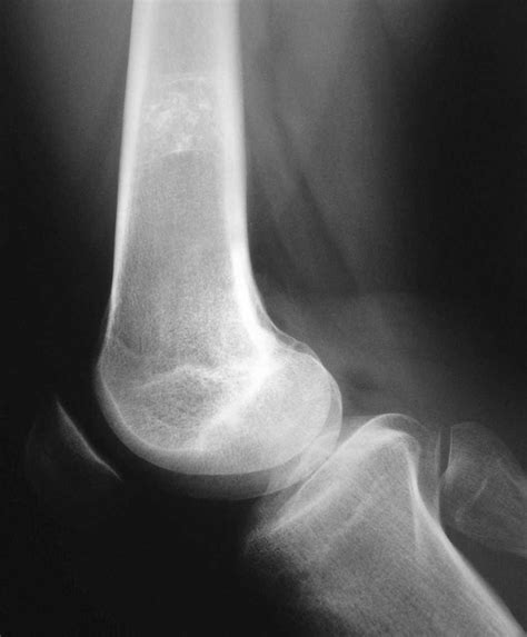 Osteocondroma: una causa de dolor de rodilla | Medicina de ...