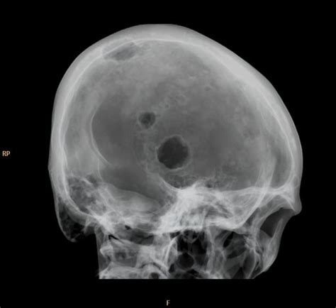 Osteolytic skull metastasis of lung cancer | Radiology ...
