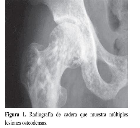 Osteopoikilosis and Buschke Ollendorf Syndrome: Case ...