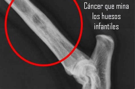 Osteosarcoma, un cáncer que azota a niños en México | e ...
