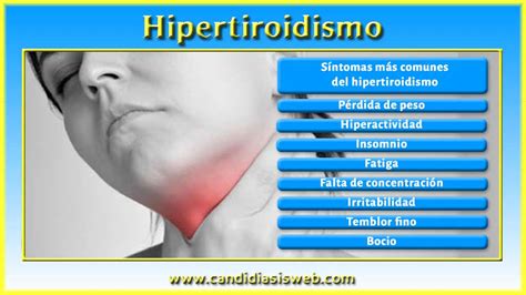 Otros Síntomas   Hipertiroidismo