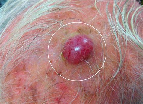 Otros tumores malignos – Dermovirtual