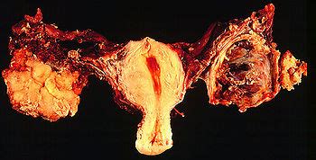 Ovarialkarzinom – Wikipedia