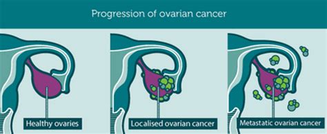 Ovarian Cancer Canada   About ovarian cancer