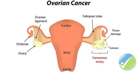 Ovarian Cancer: Early Signs, Symptoms, Causes, & Treatment