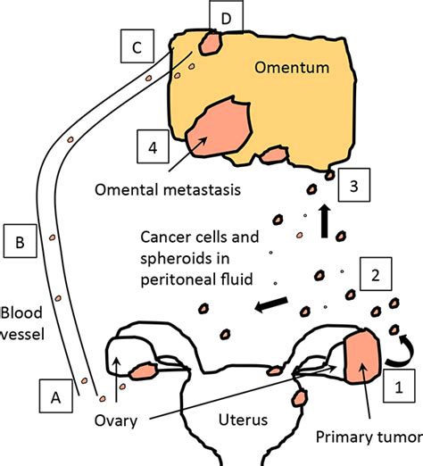 Ovarian Cancer Metastasis: A Unique Mechanism of ...
