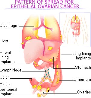 Ovarian cancer metastasis | ENCOGNITIVE.COM