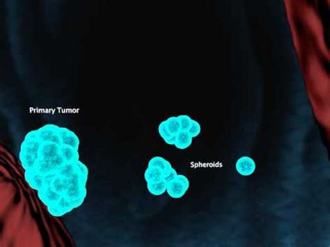 Ovarian Cancer Metastasis   YouTube