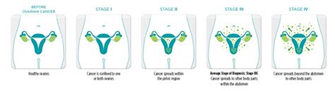 Ovarian Cancer   Physiopedia