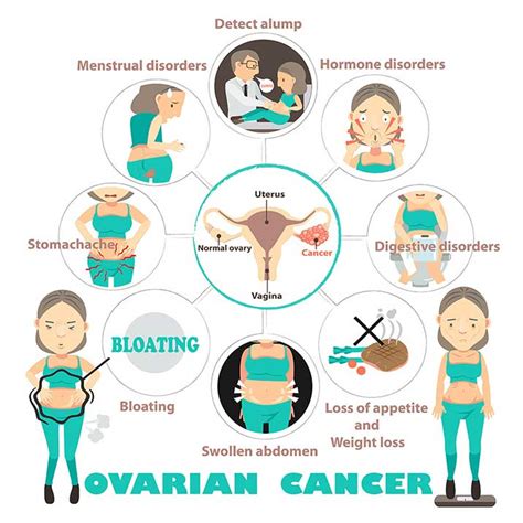 Ovarian Cancer | Symptoms, Diagnosis & Treatments