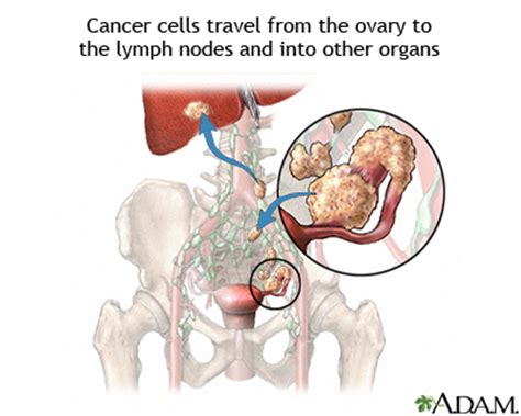 Ovarian cancer | UF Health, University of Florida Health