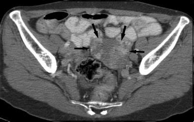 Ovarian metastasis shows distinct CT features in stomach ...