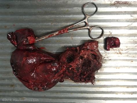 Ovarian Torsion & Benign Mature Cystic Teratoma   The Hauns in Africa