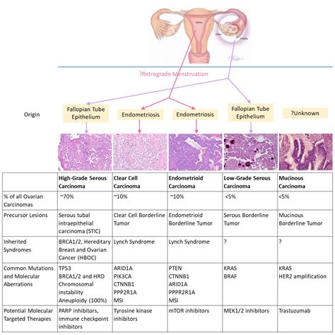 Ovary   Epithelial Carcinoma