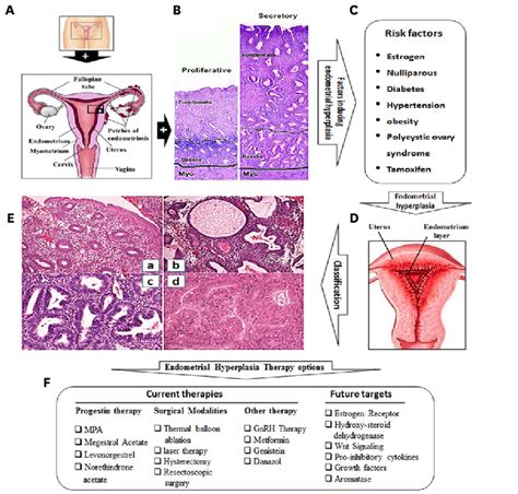 Overview of endometrial hyperplasia, risk factors, classification and ...